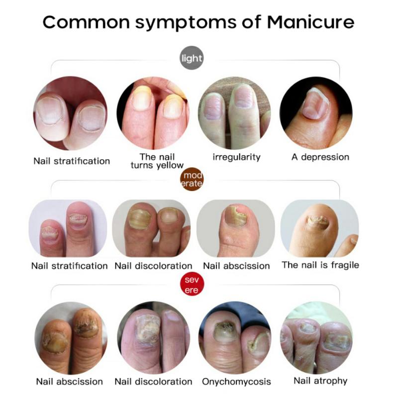 Sumifun Nail Fungus Removal Cream for Toenail Repair