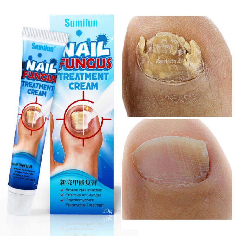 Sumifun Nail Fungus Removal Cream for Toenail Repair