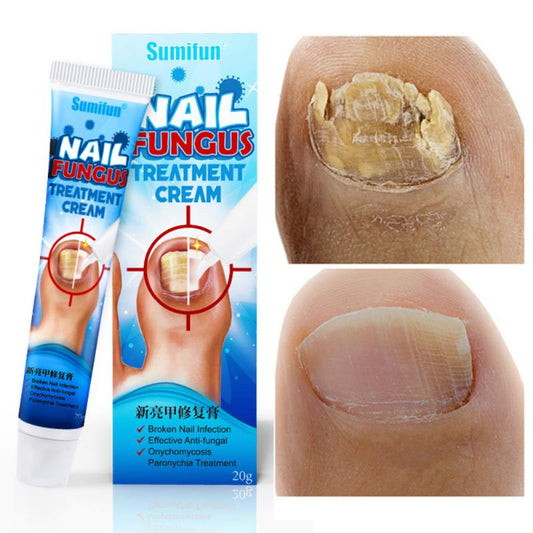 Sumifun Nail Fungus Removal Cream for Toenail Repair