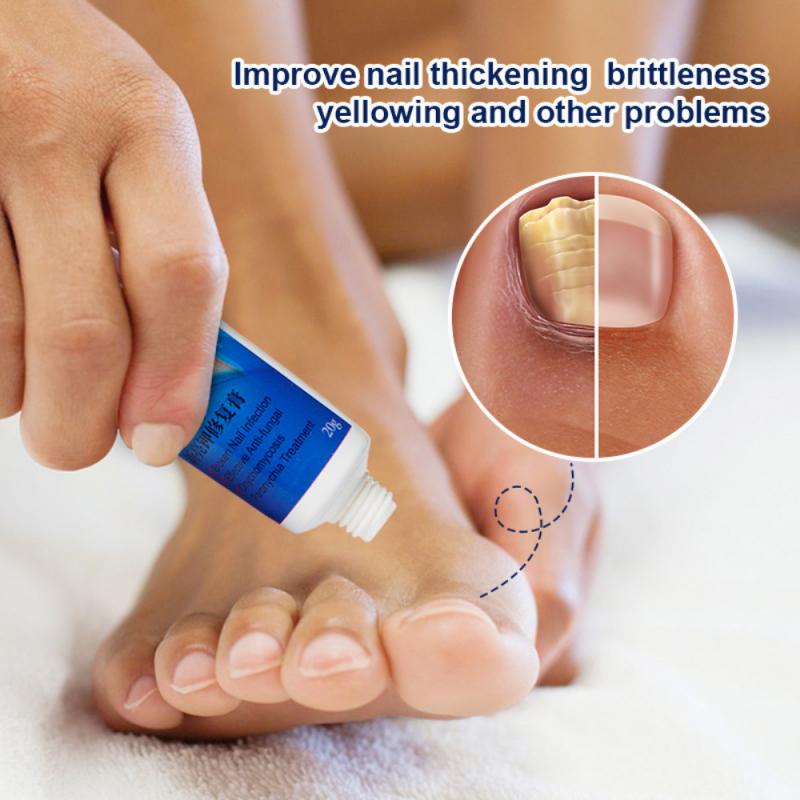 Sumifun Nail Fungus Removal Cream for Toenail Repair